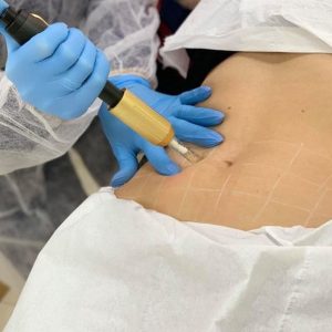 No Needle Fat Dissolve